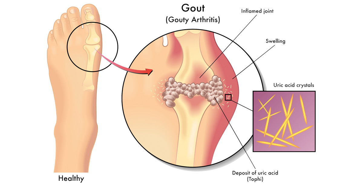 Herbal Supplements That Can Heal Gout Naturally