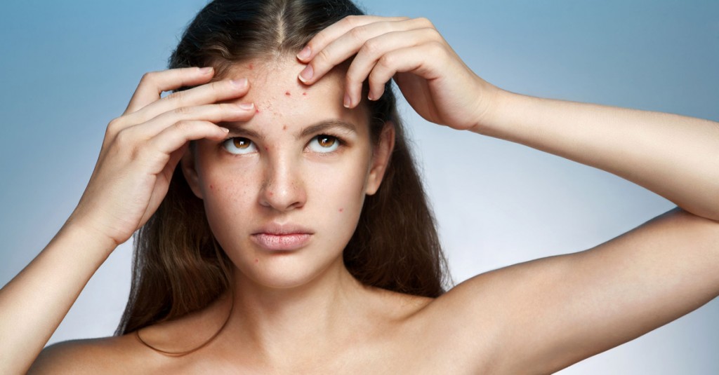 10 Reasons Your Diet Can Cause & Aggravate Acne