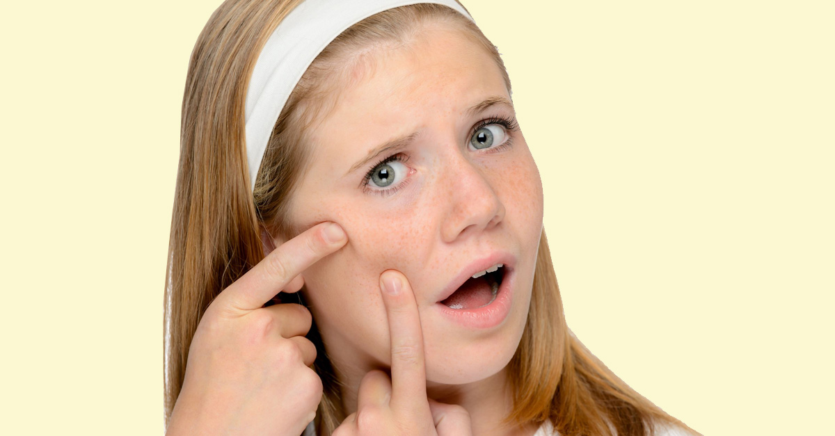 natural remedies for rosacea