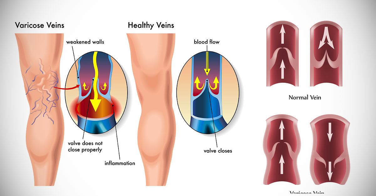 Tips_And_Remedies_For_Varicose_Veins