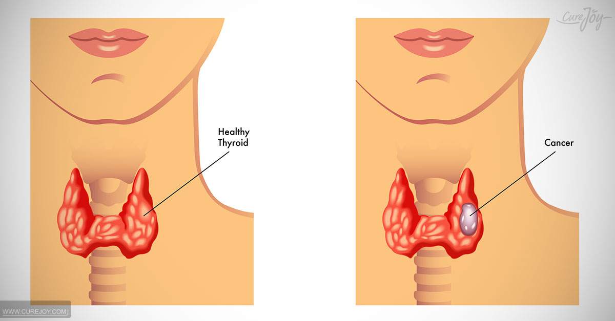 Symptoms of thyroid dirorder