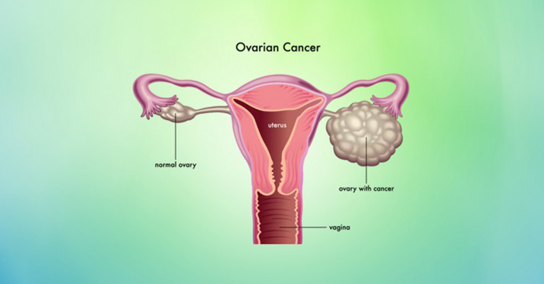 Natural-Remedies-For-Ovarian-Cancer