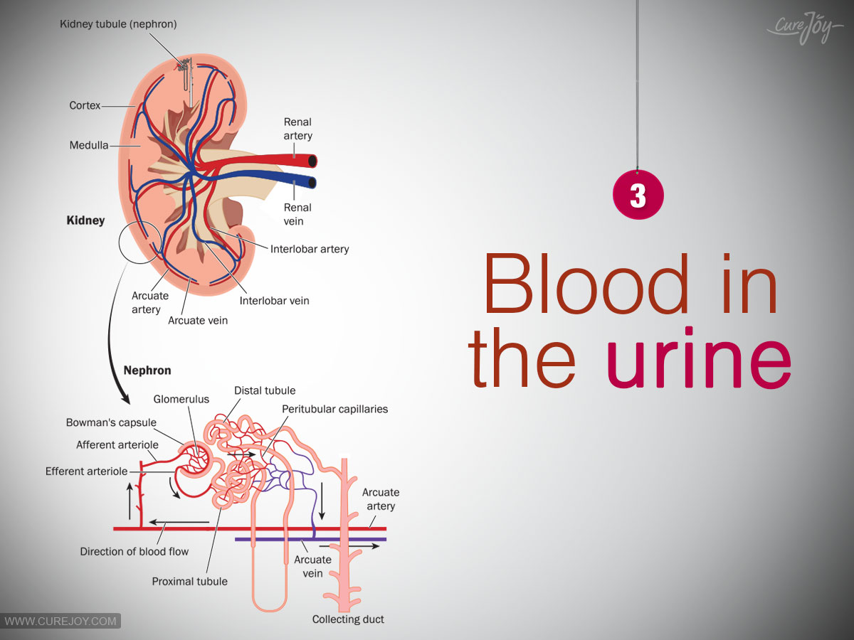 3-Blood-in-the-urine