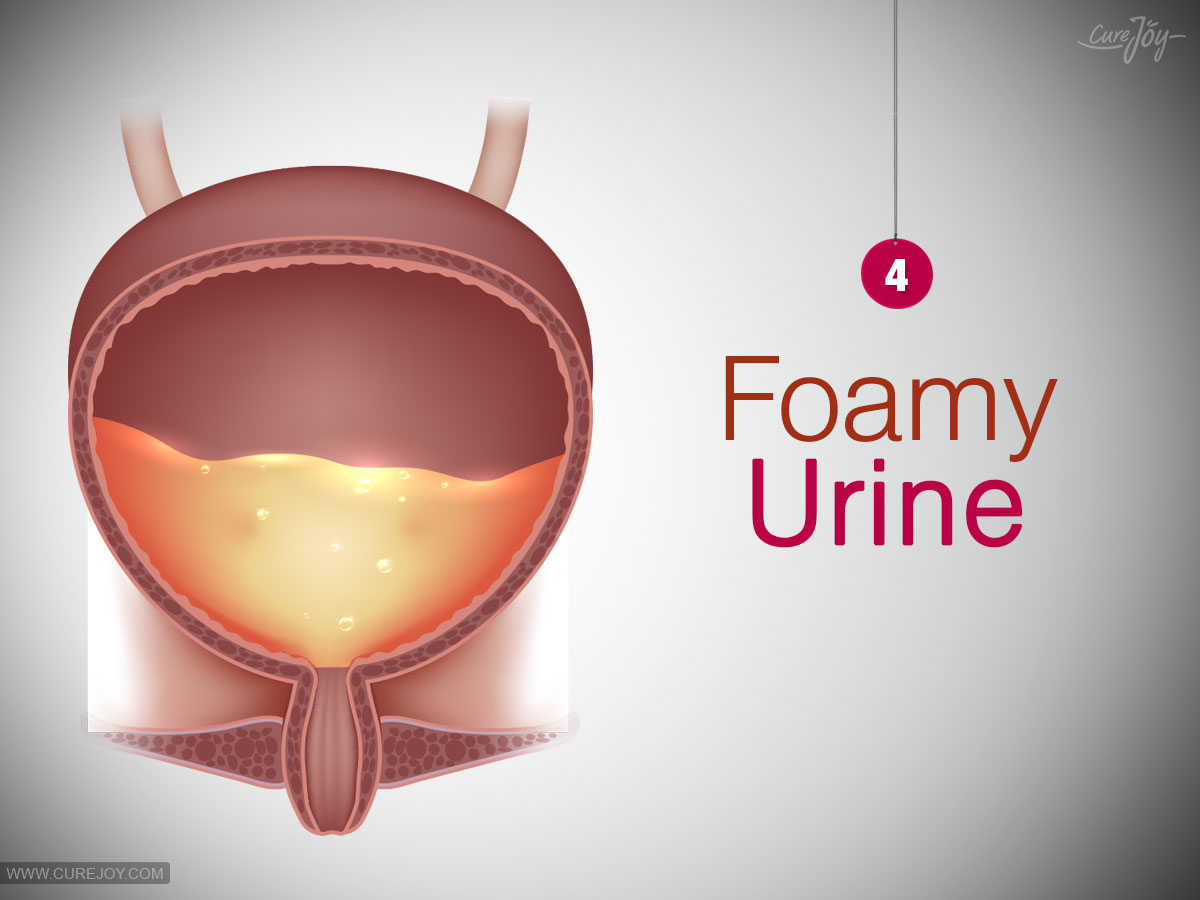 4-Foamy-Urine
