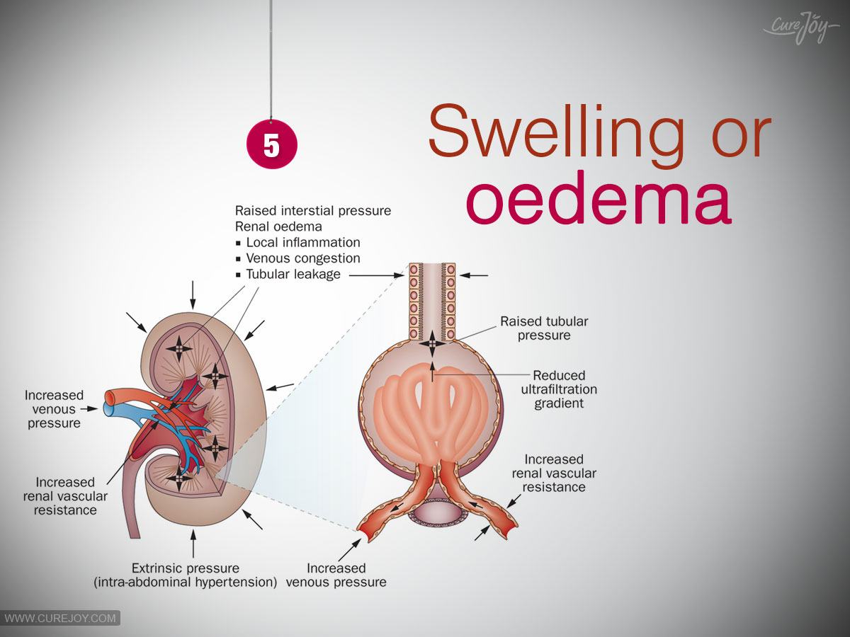 5-Swelling-or-oedema