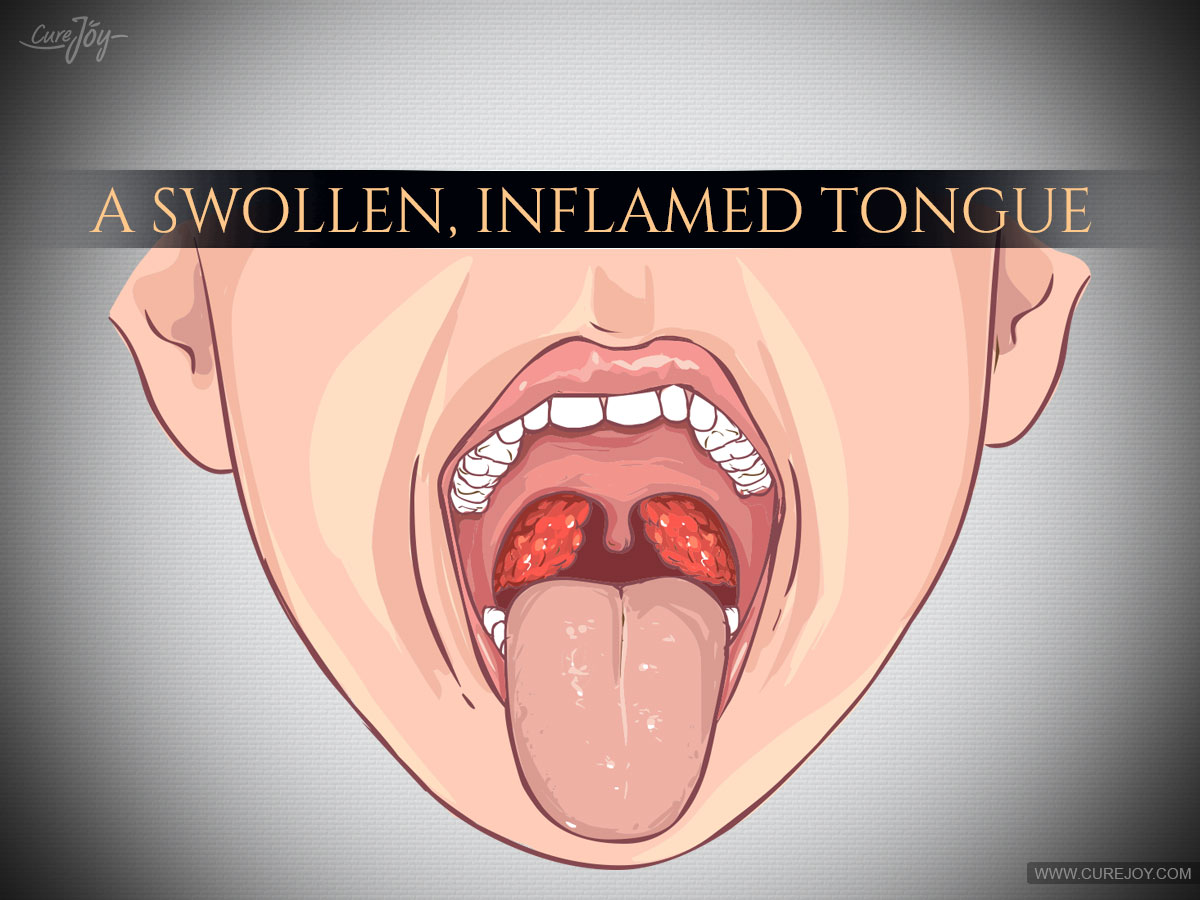 a-swollen,-inflamed-tongue