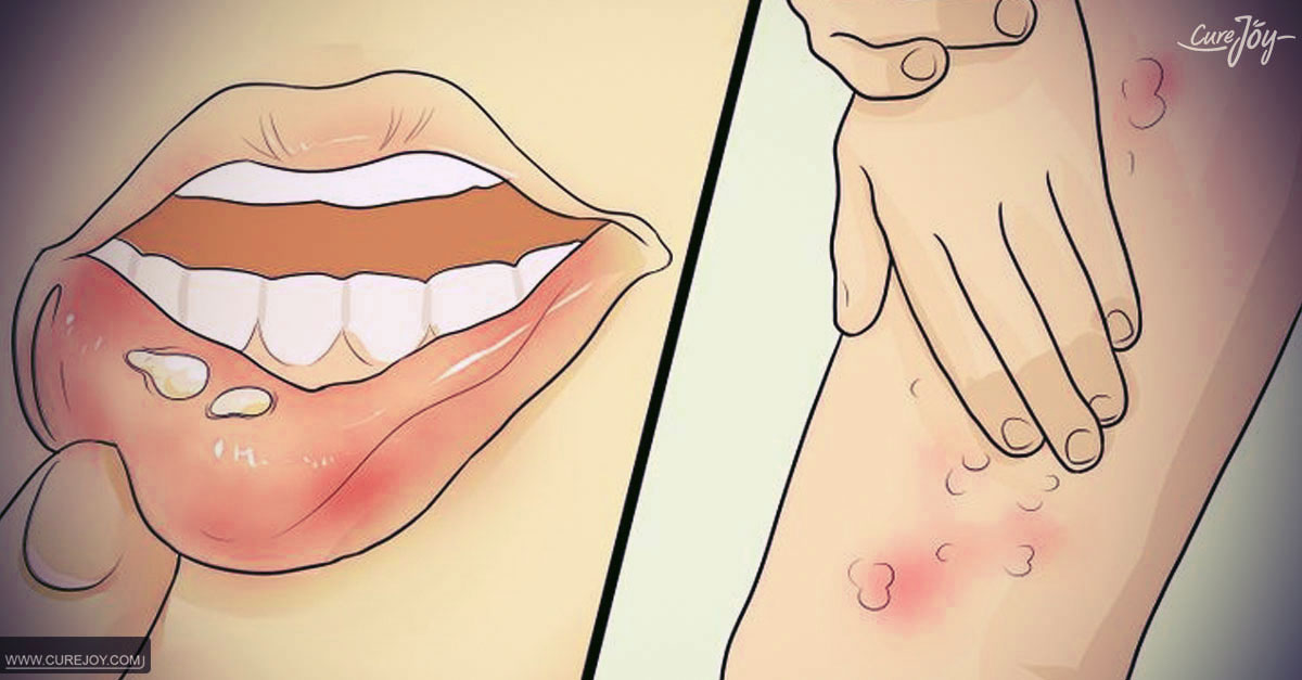 tips to get rid of herpes naturally