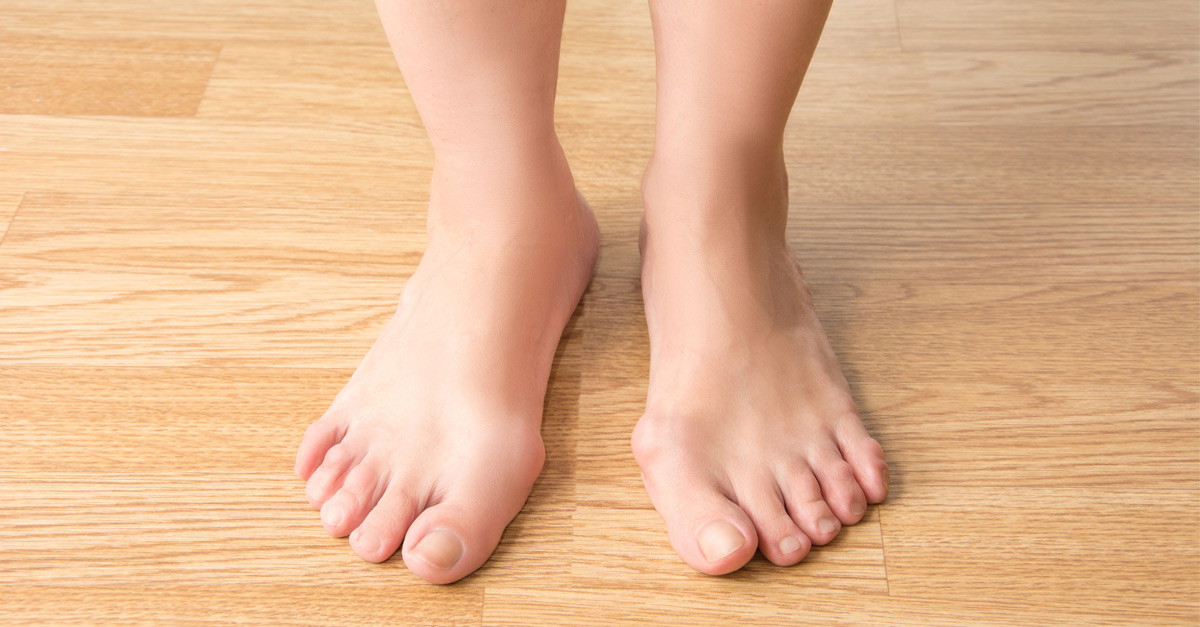 get rid of bunions naturally