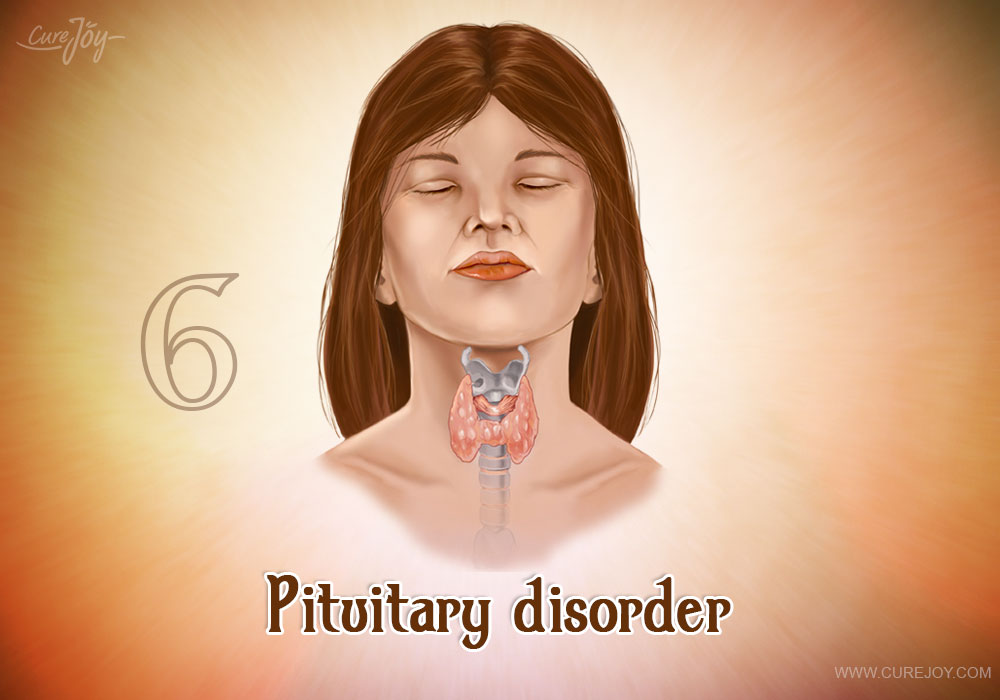 6-pituitary-disorder