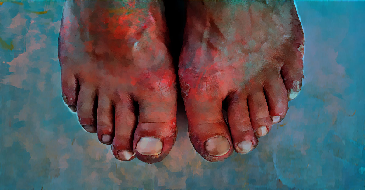 home remedies or peeling skin