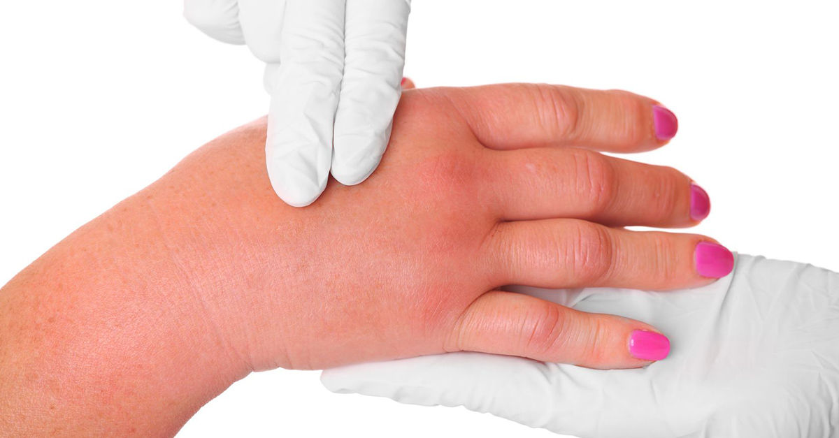 Reasons That Cause Your Fingers To Swell