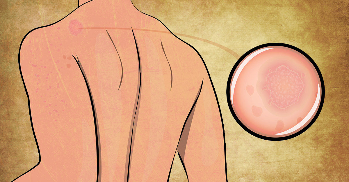 Home Remedies To Treat Pityriasis Rosea Naturally