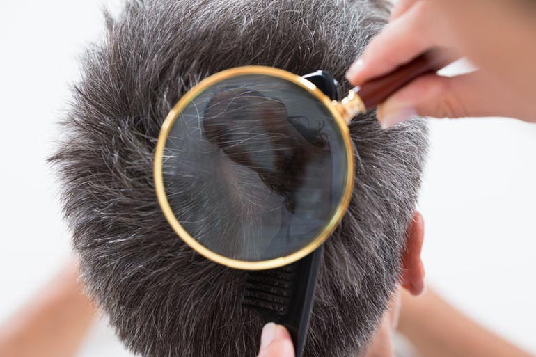 Brahmi-amla hair oil improves scalp health