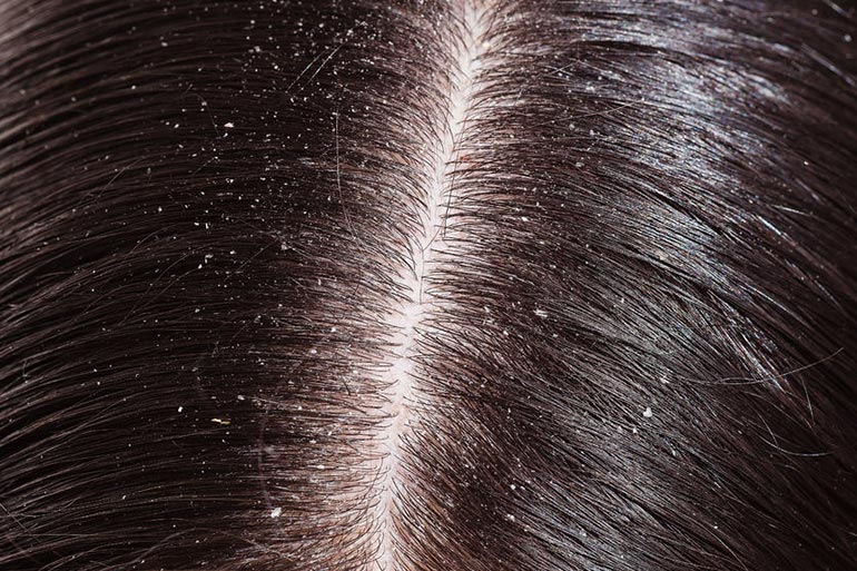 Brahmi-amla hair oil cures dandruff