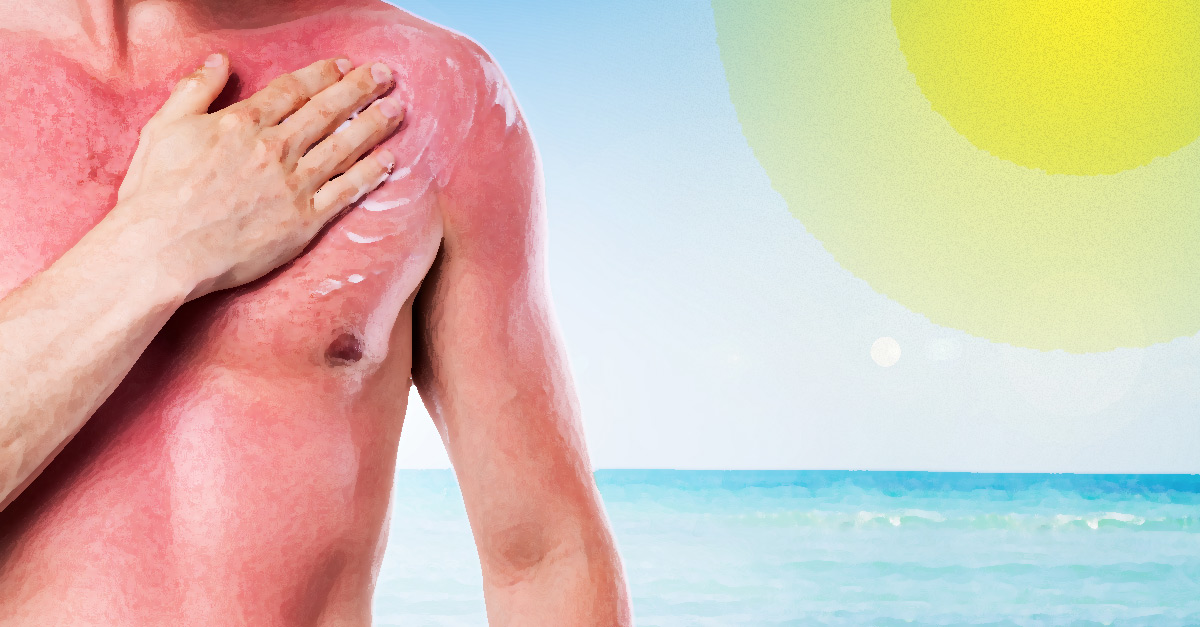 Home remedies to treat sunburn