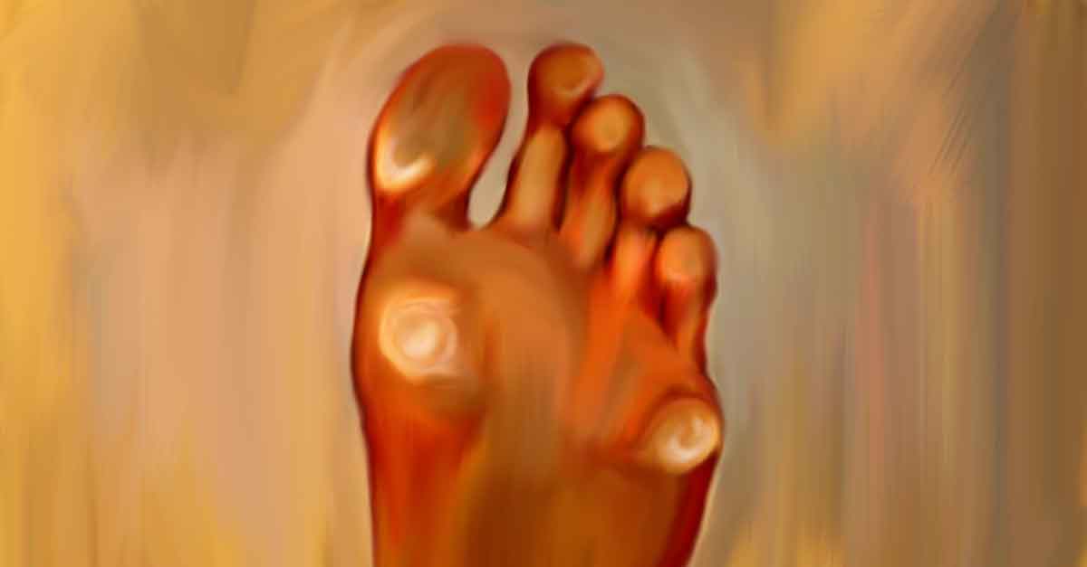 home remedies to remove calluses on your feet
