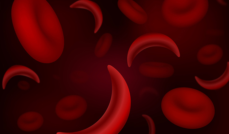 Sickle cell anemia may also cause priapism