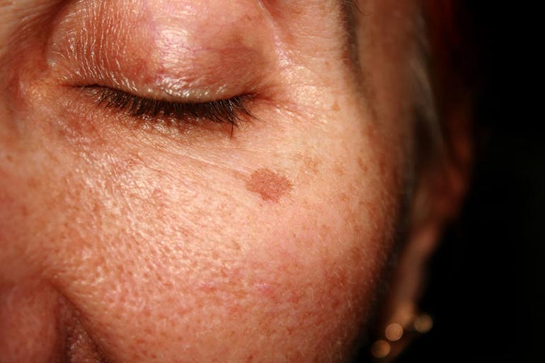 A Lemon-Strawberry Mask Works Great For Age Spots