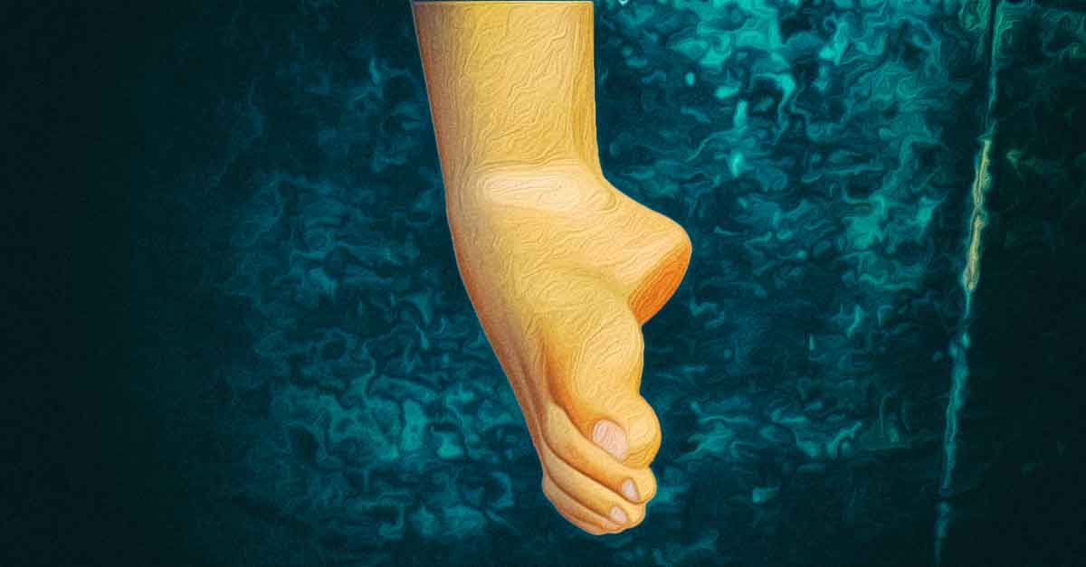 ways to treat ankle sprain