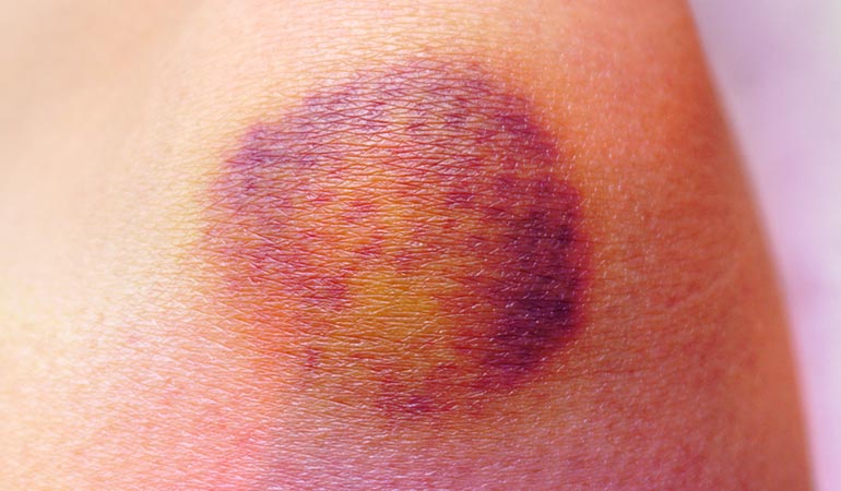 Certain essential oils can causes skin burning, sores, and discoloration in sunlight.)