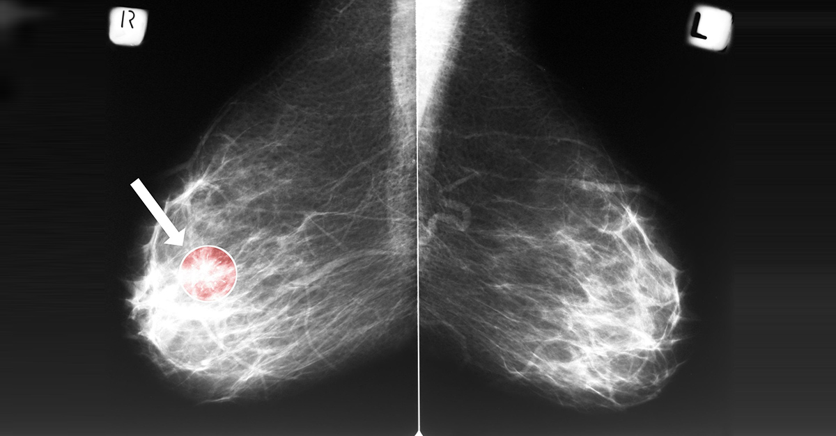 Breast cancer can come back at anytime