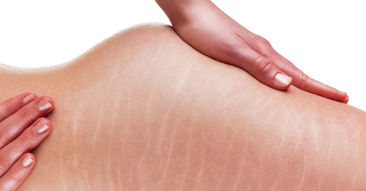 These remedies reduce the appearance of stretch marks