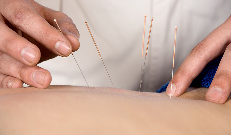 acupuncture and yoga for food allergy