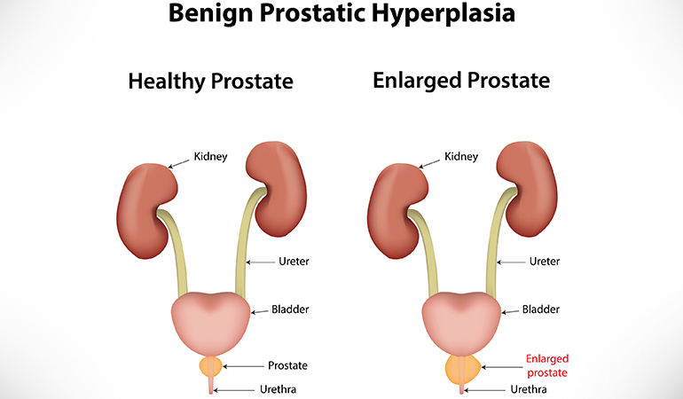 Swelling of the prostate gland causes BPH.