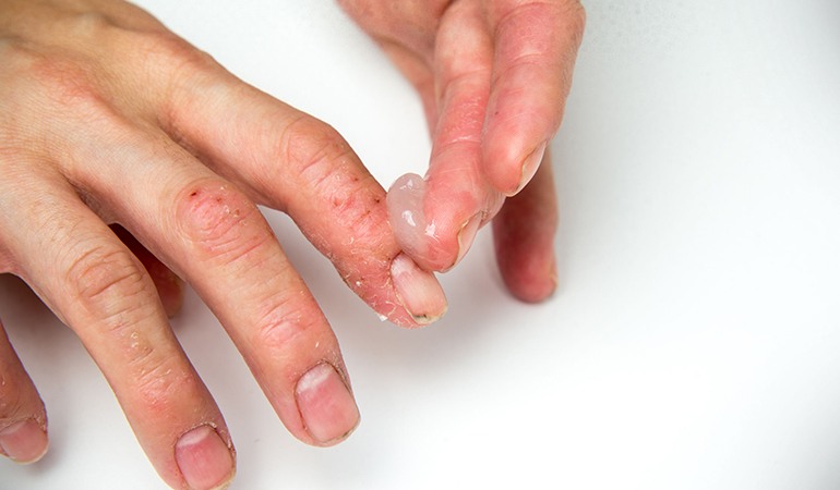 Eczema can be due to different reasons, including stress