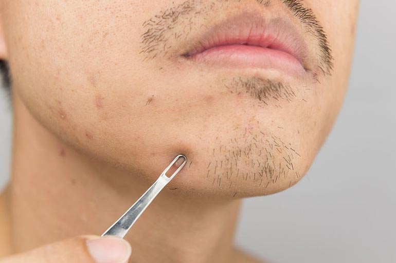 Pimples form due to the oil secreted by the sebaceous glands.
