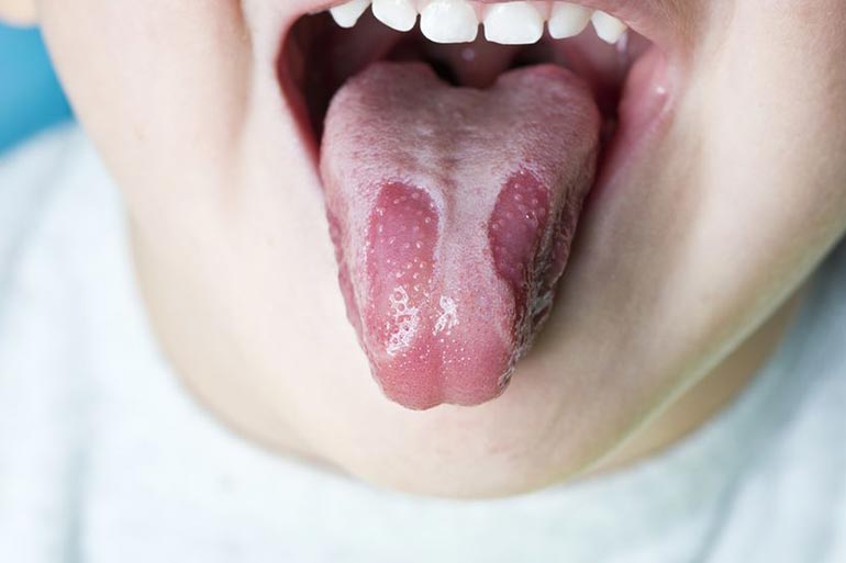 Tongue pain could be the result of having a geographical tongue.