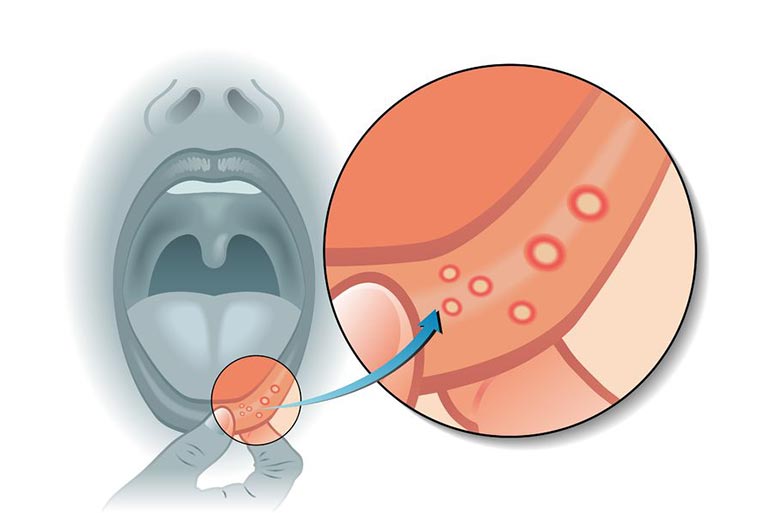 Canker sores are common causes of tongue pain.