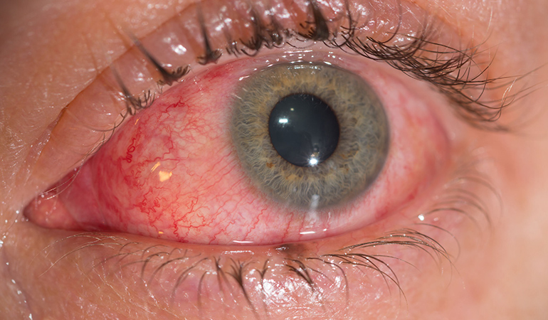 Viral conjunctivitis causes itching and burning.