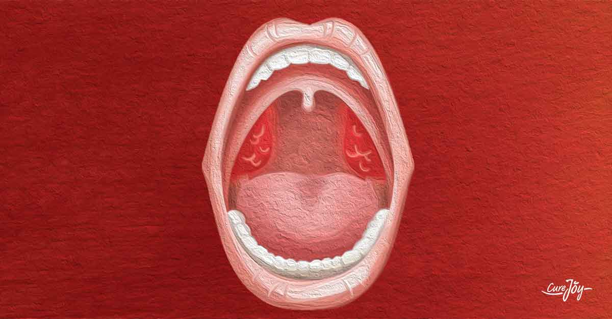 symptoms of tonsillitis
