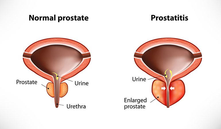 Inflammation in the prostate gland causes prostatitis.