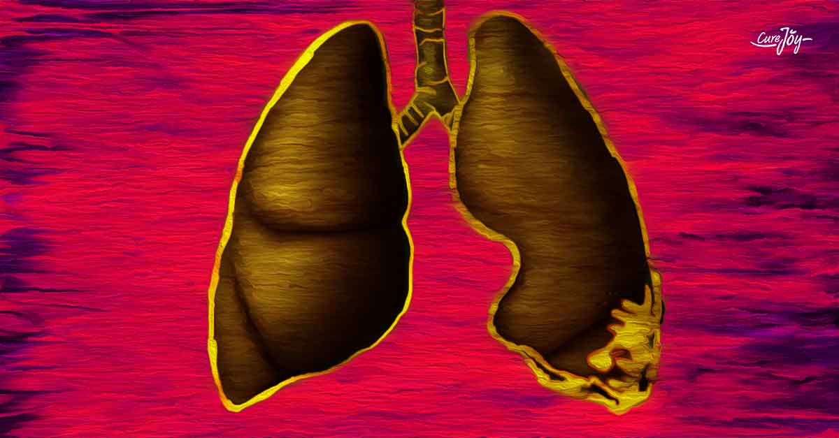 symptoms of mesothelioma
