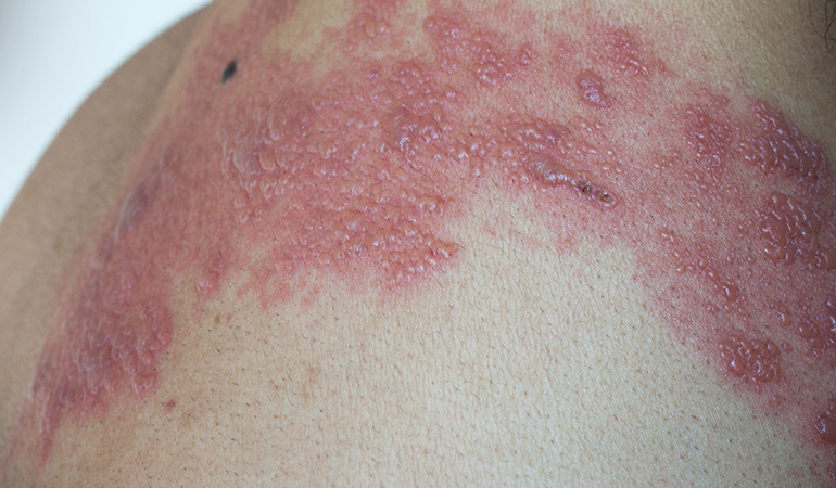 Shingles are caused by virus that causes chickenpox as well