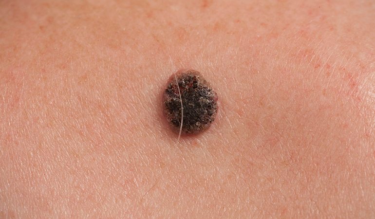 The ABCDE test can help in detecting skin cancer.