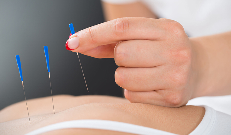 Acupuncture can improve blood flow and reduce stagnation that helps to relieve pain