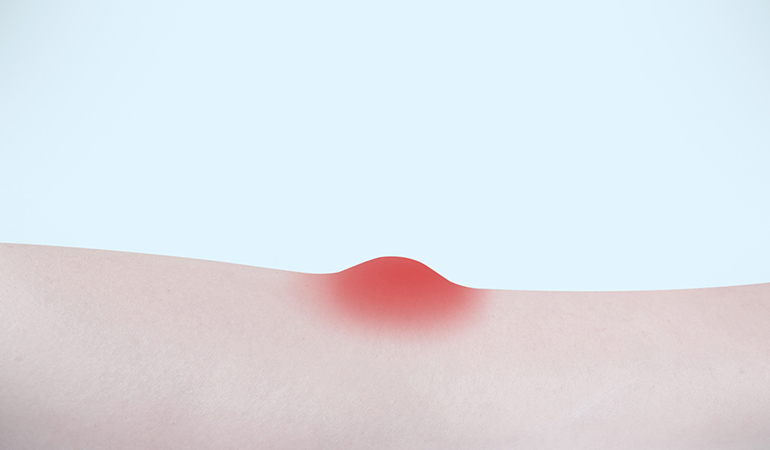 Sweat Lumps Are Bumps Caused Due To Blocked Sweat Glands