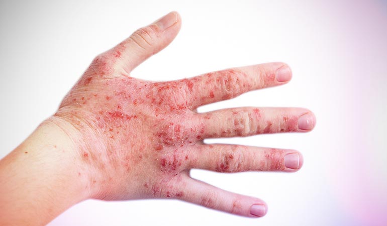 People suffering from eczema can feel their skin might tip over any moment.)