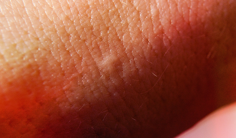 Bed bug bites often come in threes
