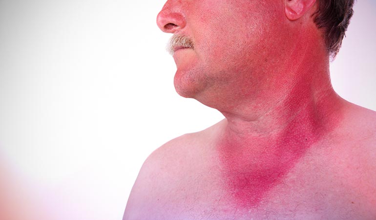A recurring bad sunburn could be a case of rosacea.)