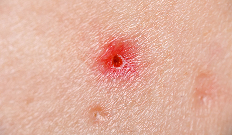 A pimple-like formation on the chest may be due to basal cell carcinoma