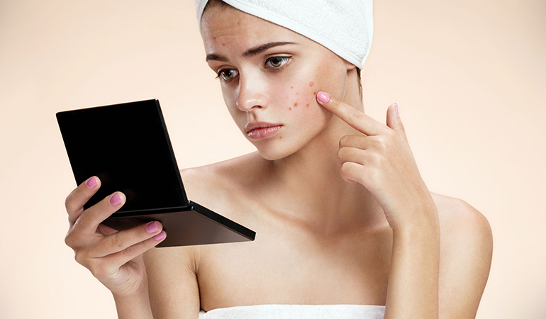 Acne on the cheeks could be due to excess exposure to pollutants and bacteria