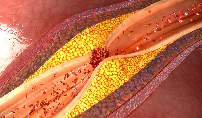 Blocked Arteries Is The Problem, Not High Blood Pressure