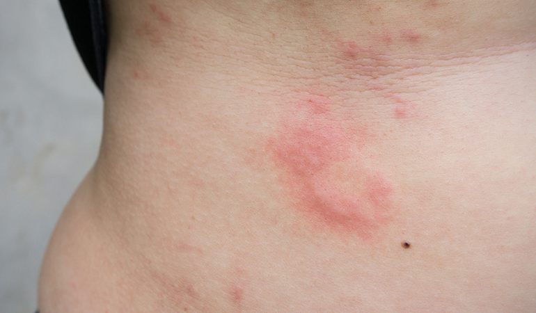 Hives can be the result of an allergy.