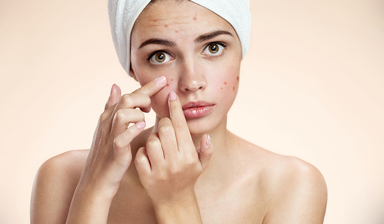 Sandalwood Prevents Acne Significantly