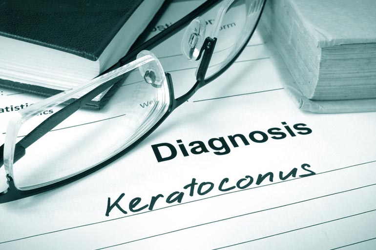 Usually more common amongst Asians, keratoconus is mostly diagnosed in teenagers and young people.