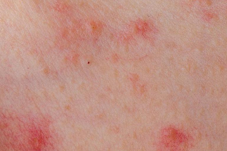 Fungal infections are common in women